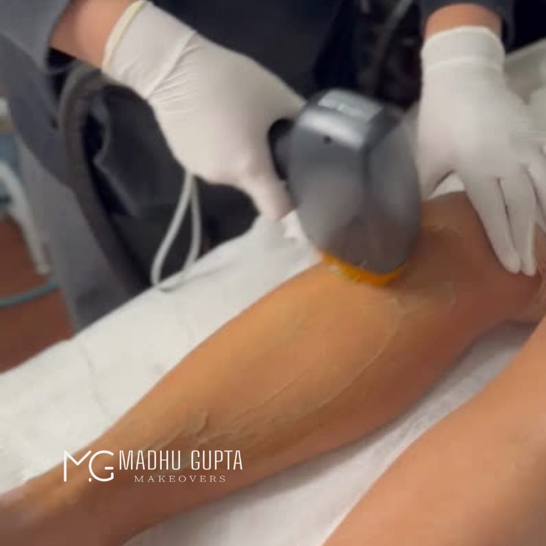 Laser hair removal treatment on a client's leg at MG Makeovers, with cooling gel applied